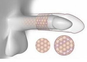 Increase in the penis in volume